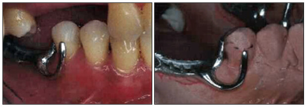 Fig.2. Con la utilización del retenedor R.P.I. en casos del maxilar inferior, se logra una mejor estética. 