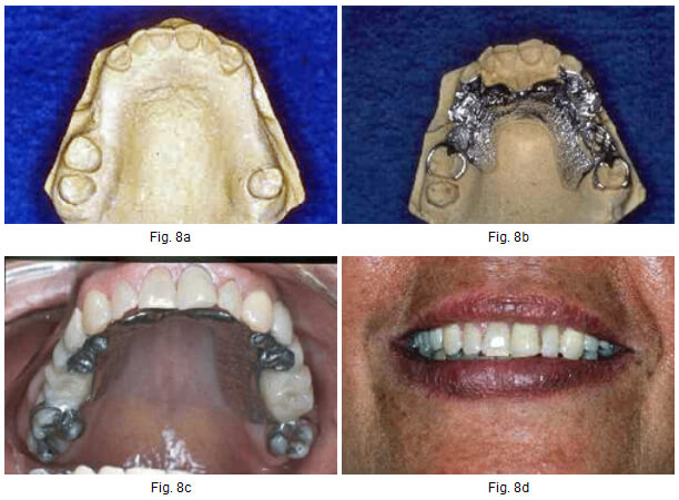 Fig.# 8. Caso Clínico. Tratamiento con p.p.r. con Eje rotacional de inserción.