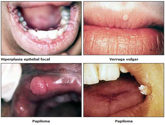 virus del papiloma reacciones