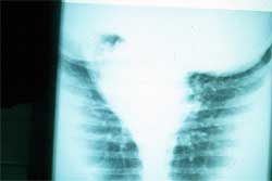 Fig. 3 Radiografía del pulmón