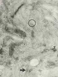 Fig. 11: En esta micrografía electrónica, circulo-ausencia de línea M y banda H; Z-cuerpo denso; flecha-triada prominente. Aumento: 37.500X.