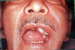 Fig.2: Aspecto intrabucal superficial donde se pone de manifiesto la dificultad para cerrar la boca, debido a la masa tumoral que proyecto el molar inferiormente.