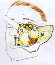 Fig.5: Maxilectomía total, a través de la incisión de Weber-Fergusson donde se muestra los sitios donde se secciona el maxilar superior.