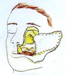 Fig.6: Nótese el defecto consecutivo a la maxilectomía total.