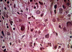 Fig.7 La microscopía de luz revela capas de células que carecen de patrón arquitectónico y muestran anomalías celulares intensas que consisten en hipercromatismo y pleomorfismo, alteración en la relación núcleo/citoplasma, gigantismo nuclear y figuras mitóticas unipolares, bipolares y multipolares.