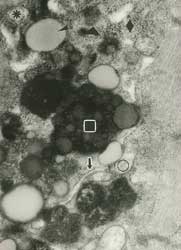 Fig. 8: En esta micrografía electrónica, asterisco-vacuola autofágica; triángulo- lisosoma primario; cuadrado-gránulo de lipofuscina; circulo-mitocondria; flecha-retículo endoplasmático rugoso; cabeza de flecha-gota lipídica; rombo-glucógeno tipo b. Aumento: 37.500X.