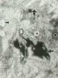Fig. 9: En esta micrografía electrónica, asterisco-vacuola autofágica; triángulo- lisosoma primario; circulo-mitocondria; cabeza de flecha-gota lipídica; flecha-núcleo. Aumento: 22.500X.
