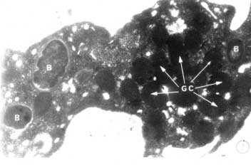 FIGURA 3: Corte longitudinal de T. tenax, mostrando los gránulos de cromatina (o hidrogenosomas): (GC). También se nota la presencia de bacterias fagocitadas por las vacuolas: (B). (X 12.500). Tomado de Ribaux14.