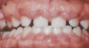 Fig. 1-a Obsérvese el agrandamiento gingival de apariencia fibrosa.