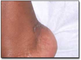 Figura 2: Úlcera costrosa en pie derecho.