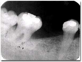 Figura 6: Rx periapical zona 7 8 inferior