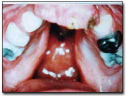 Figura 2. Hendidura labio-palatina bilateral completa, microdoncia, oligodoncia, caries rampante, hipoplasia del esmalte.