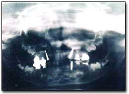 Figura 5: Radiografía Panorámica postoperatoria que da un aspecto global del tratamiento dental realizado durante el acto anestésico.