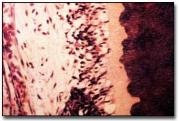 Fig. 1- Efecto del Laser de Er:YAG en el tejido pulpar. Note la apariencia normal de la capa odontoblástica en el área tratada. Fotomicrografía X 400. Tinción con Hematoxilina y Eosina. (Tomado de Zakariasen K. L.)