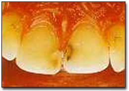 Fig. 10.- Tratamiento de la caries en los centrales superiores con un Rayo Laser de Er:YAG. Aspecto clínico. (Tomado de Miserendino L., Pick R.)