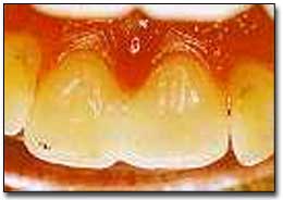 Fig. 12.- Dientes estéticamente reconstruidos con resinas fotocuradas. (Tomado de Miserendino L., Pick R.) 