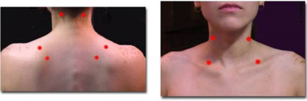Figuras 1 y 2: Puntos gatillo que pueden ser fácilmente detectados por el odontólogo en cuello y espalda