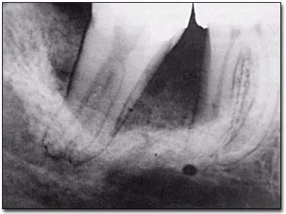 Figura 1 – TOE: aspecto radiográfico en el proceso alveolar  Fuente: Goldblatt, 1982