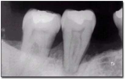 Figura 3 – Diagnóstico diferencial con enfermedadperiodontal Fuente: Propia