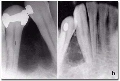 Figura 4 - Diagnóstico diferencial: a = TOE;  b = Ameloblastoma unicistico