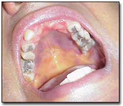 Sarcoma de Kaposi y hepatitis