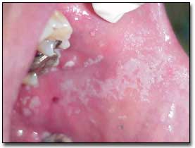 Candidiasis Pseudomembranosa e hiperpigmentación melaninica