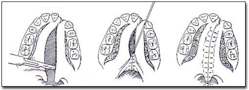 Figura N°1. Fuente: Cirugía Bucal de H. Archer