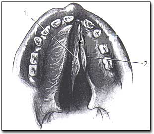 Figura N°2. 1. Colgajo de mucosa del Vomer, 2. Colgajo de mucosa palatina Fuente: Tratado de Cirugía Bucal de G. Kruger