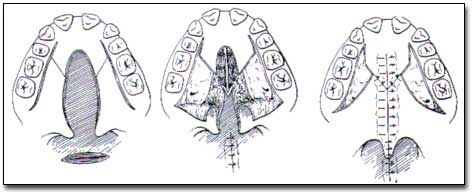 Figura N°3 Fuente: Cirugía Bucal de H. Archer