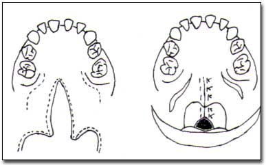 Figura N° 5. 1. Incisiones 2. Sutura.
