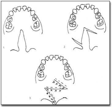 Figura N° 6. 1. Paladar hendido 2. Incisiones 3. Sutura.