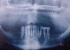Figura 1. Radiografía Panorámica. Se observa una imagen radiolúcida unilocular amplia rodeada de un halo radiopaco ubicada en zona periapical y perrirradicular de 33 y 34, desplazando sus raíces.