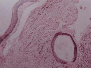 Figura 3. Imagen histopatológica. Epitelio plano estratificado. Estroma inflamado. Islotes de epitelio similar al epitelio de revestimiento. “Quistes hijas”.