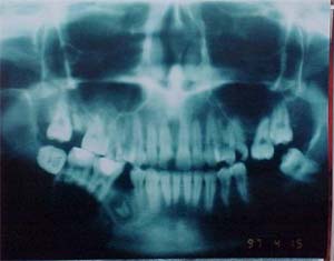 Figura 5. Radiografía Panorámica. Se observa imagen radiolúcida multilocular rodeada  de un    halo radiopaco de 7x5x4 cm que se extiende desde la zona del 45 hasta la Escotadura Sigmoidea. Se observa imagen compatible con resto radicular.