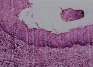 Figura 7. Imagen histopatológica. Epitelio plano estratificado con una capa de paraqueratina. Islotes de epitelio. Estroma inflamado. Pared de quiste con fibrosis e inflamación acentuada