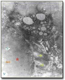 Fig. 3 Sección de la fibra hipercontraída (asterisco). Se puede apreciar mitocondria hinchada (MIT) y vacuolas (v). En otra sección, un gránulo de lipofucsina (LF). Nótese el plegamiento del sarcolema (flechas). X 45.000