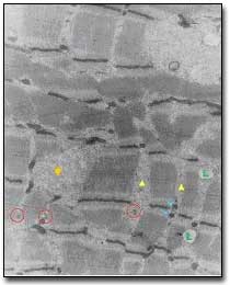 Fig. 4 Presencia de amplios espacios intermiofibrilares (triángulo). La fibra IIA presenta tríadas prominentes (circulo), mitocondrias (flechas) de un contenido electrondenso, glucógeno particulado (rombo) y gotas lipídicas (L). X 26.700