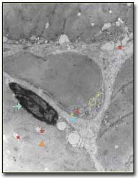 Fig. 6 En esta sección se aprecia fibra supercontraída, (triángulo) con presencia de un núcleo hipercromático (flecha) mitocondrias hinchadas (asterisco) y una vacuola autofágica. El capilar presenta una luz amplia y un citoplasma endotelial poco electrón denso, con cisternas del retículo endoplasmático rugoso (cabeza de flecha), una mitocondria hinchada y un centríolo. Nótese lo escaso de las vesículas pinocíticas (circulo). X. 18.000