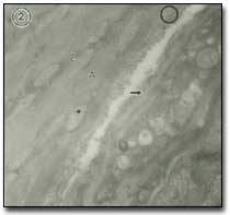 Figura 2 En esta micrografía electrónica, Z: línea Z; A: banda A; círculo: filamentos de colágeno; asterísco: mitocondria de baja densidad electrónica; flecha: membrana basal del capilar. Aumento: 30.000.