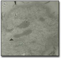 Figura 5 En esta micrografía electrónica: flechas: vesículas; rombo: miofilamentos; asterísco: mitocondrias; cabeza de flecha: membrana basal engrosada. Aumento: 30.000.