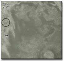Figura 6 En esta micrografía electrónica: flechas: irregularidades del núcleo; círculo: fibrillas de colágeno. Aumento: 24.000.