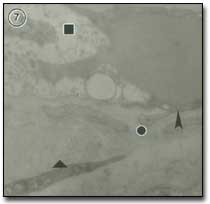 Figura 7 En esta micrografía electrónica: cuadrado: área electrontransparente del citoplasma endotelial, cabeza de flecha: área electrondensa del endotelio; rombo: prolongación morfológica; círculo: membrana basal engrosada. Nótese lo irregular de la distribución de las caveolas en el área electrontransparente del endotelio. Aumento: 24.000