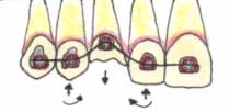Fig. 1. Efectos producidos por un arco continuo flexible durante la erupción forzada de un diente.
