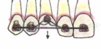 Fig. 3. Esquema del uso del doble arco en la erupción forzada de un canino superior.