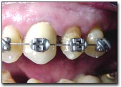 Fig. 6 Colocación del doble arco