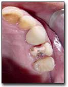 Fig. 8 Recementado del bracket