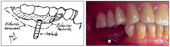 Figura 3 Esquema y clínica de utilización de implante en P.P.R. a extensión distal