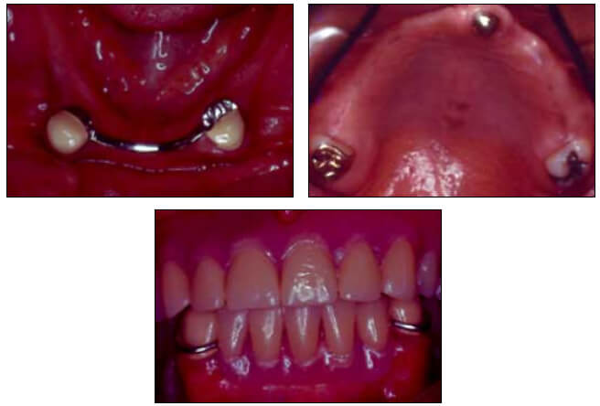 Figura 4 Caso clínico maxilar inferior tratado con barra ferulizadora entre 34 y 43, y retenedores tipo RPA; maxilar superior se prepara cofia colada en la zona anterior por razones estéticas y prevenir resorción del hueso, en la zona posterior a nivel de 28 y18 se colocara retenedores tipo gancho para sobredentadura parcial removible.