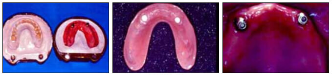 Figura 5 - e: Modelo de trabajo en la mufla con broche negro del sistema ERA para procesar la dentadura. Vista interna de la dentadura donde ya se ha sustituido el broche negro de procesado por el blanco de retención. Aditamentos cementados.