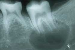 Figura 5 Rx. Periapical zona del 36